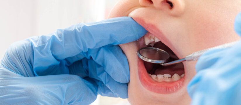 caries y cómo se forma en los dientes de los niños