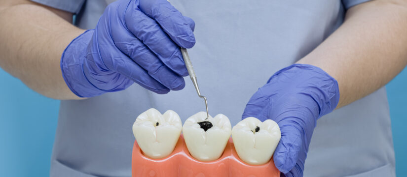 caries profundas que llegan al nervio