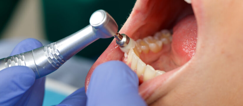 Beneficios de una limpieza dental para detectar problemas a tiempo