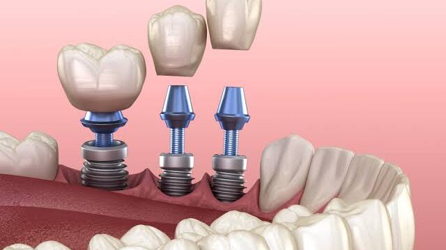 El papel del hueso en los implantes dentales